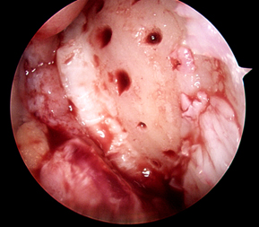 Bleeding occurs from holes