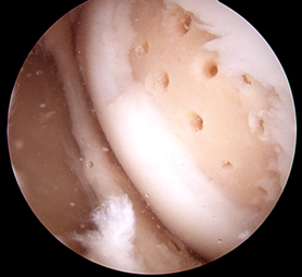 Holes drilled in bone