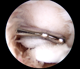 Cartilage injury identified