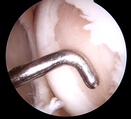 Damaged cartilage cleared leaving bare bone